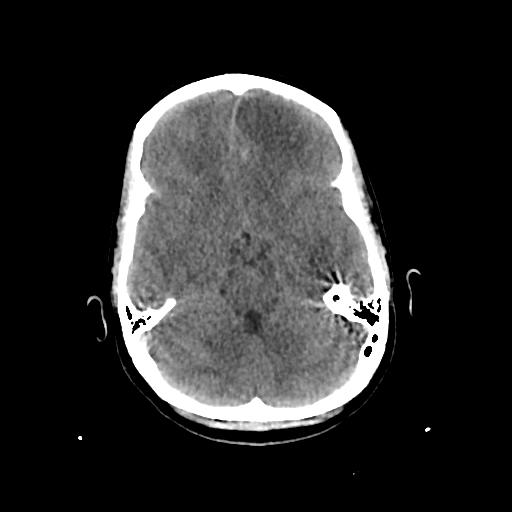 Cerebral venous throbmosis - hemorrhagic venous infarction (Radiopaedia 87318-103613 Axial non-contrast 54).jpg