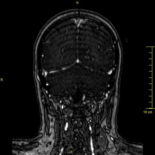 Cerebral venous thrombosis (Radiopaedia 23288-23351 MRV 131).JPG