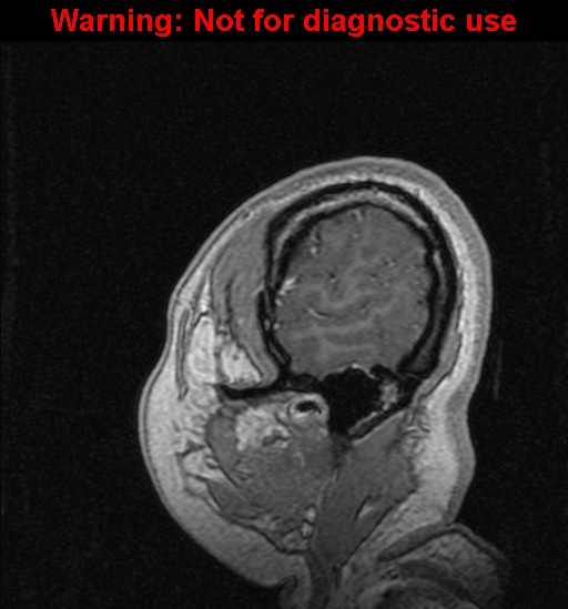 Cerebral venous thrombosis (Radiopaedia 37224-39208 Sagittal T1 C+ 138).jpg