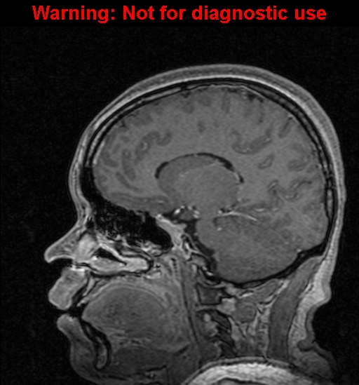 Cerebral venous thrombosis (Radiopaedia 37224-39208 Sagittal T1 C+ 64).jpg