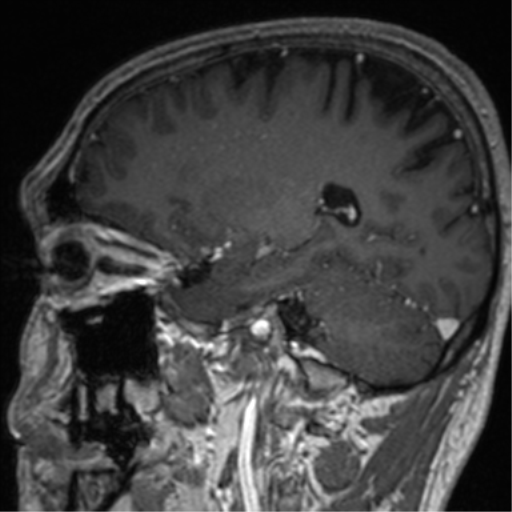 Cerebral venous thrombosis (Radiopaedia 38392-40469 Sagittal T1 C+ 33).png