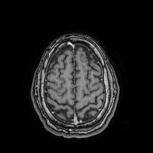 File:Cerebral venous thrombosis with secondary intracranial hypertension (Radiopaedia 89842-106957 Axial T1 C+ 141).jpg