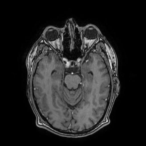 File:Cerebral venous thrombosis with secondary intracranial hypertension (Radiopaedia 89842-106957 Axial T1 C+ 76).jpg