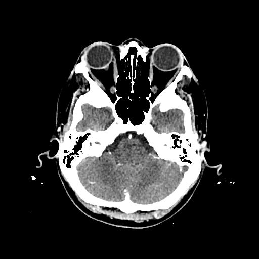 Cerebral venous thrombosis with venous hemorrhagic infarct (Radiopaedia 90354-107660 Axial with contrast 41).jpg