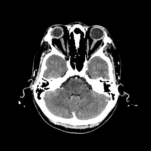 File:Cerebral venous thrombosis with venous hemorrhagic infarct (Radiopaedia 90354-107660 Axial with contrast 46).jpg