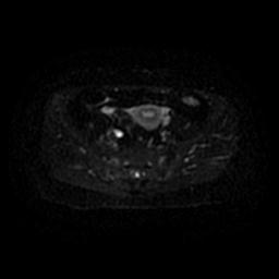 File:Cervical carcinoma (Radiopaedia 67644-77047 Axial DWI 31).jpg
