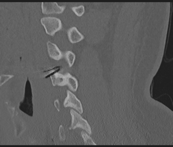Cervical disc replacement (Radiopaedia 44025-47541 Sagittal bone window 52).png