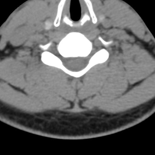Cervical schwannoma (Radiopaedia 57979-64974 Axial non-contrast 44).png