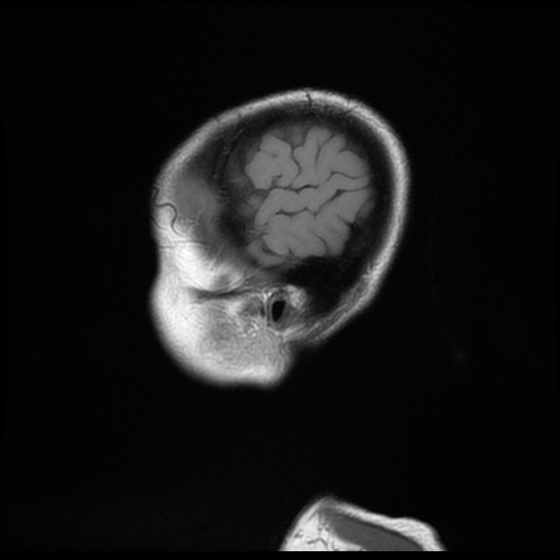 File:Cervical spondylodiscitis and calvarial hemangioma (Radiopaedia 64317-73103 Sagittal T1 25).jpg