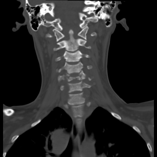 Cervical tuberculous spondylitis (Radiopaedia 39149-41365 Axial bone window 1).png