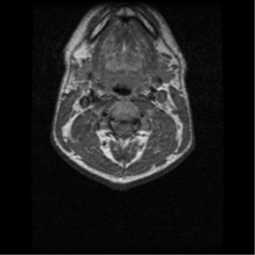 File:Cervical vertebrae metastasis (Radiopaedia 78814-91667 Axial T1 3).png