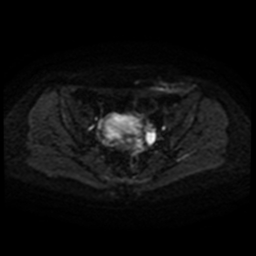 File:Cesarian section scar endometriosis (Radiopaedia 66520-75799 Axial DWI 36).jpg
