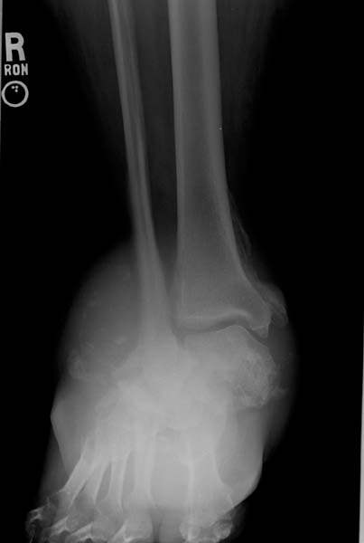 File:Charcot joint (Radiopaedia 11294-11658 Frontal 1).jpg