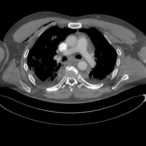 File:Chest multitrauma - aortic injury (Radiopaedia 34708-36147 A 128).png