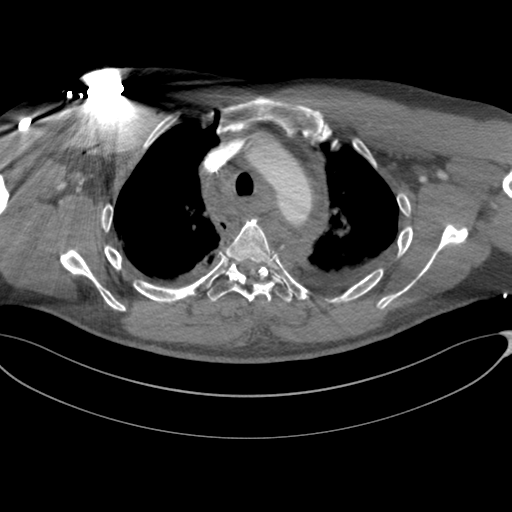 File:Chest multitrauma - aortic injury (Radiopaedia 34708-36147 A 82).png