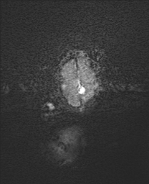 Chiari III malformation with occipital encephalocele (Radiopaedia 79446-92559 Axial SWI 1).jpg