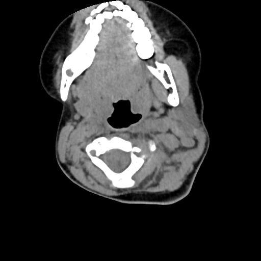 Chiari I with syrinx and skull base anomalies (Radiopaedia 89444-106412 Axial non-contrast 64).jpg