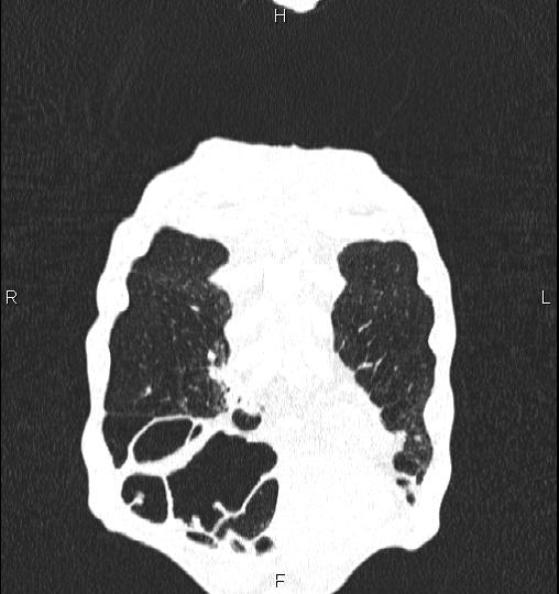 Chilaiditi sign (Radiopaedia 88839-105611 Coronal lung window 7).jpg