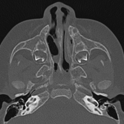 Choanal atresia (Radiopaedia 88525-105975 Axial bone window 27).jpg