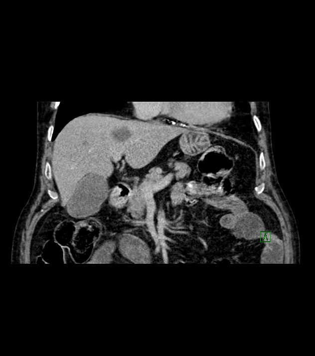 Cholangiocarcinoma with cerebral metastases (Radiopaedia 83519-98629 Coronal C+ delayed 32).jpg