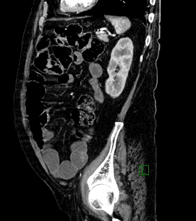 Cholangiocarcinoma with cerebral metastases (Radiopaedia 83519-98629 F 36).jpg
