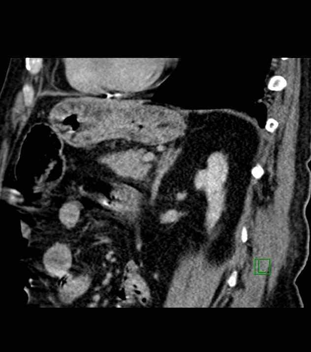 Cholangiocarcinoma with cerebral metastases (Radiopaedia 83519-98629 Sagittal C+ delayed 42).jpg