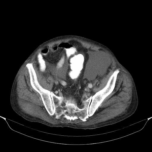 File:Cholangitis and abscess formation in a patient with cholangiocarcinoma (Radiopaedia 21194-21100 A 41).jpg