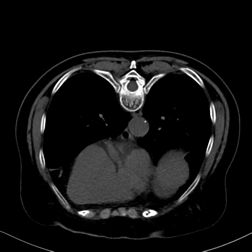File:Cholecystitis - obstructive choledocholitiasis (CT intravenous cholangiography) (Radiopaedia 43966-47479 Axial 63).png
