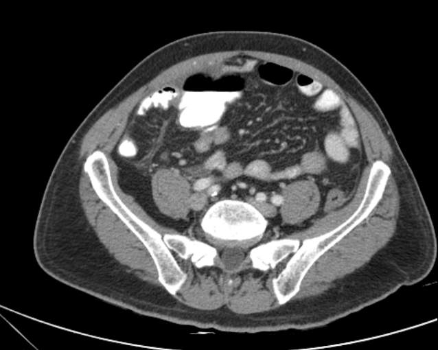 File:Cholecystitis - perforated gallbladder (Radiopaedia 57038-63916 A 59).jpg