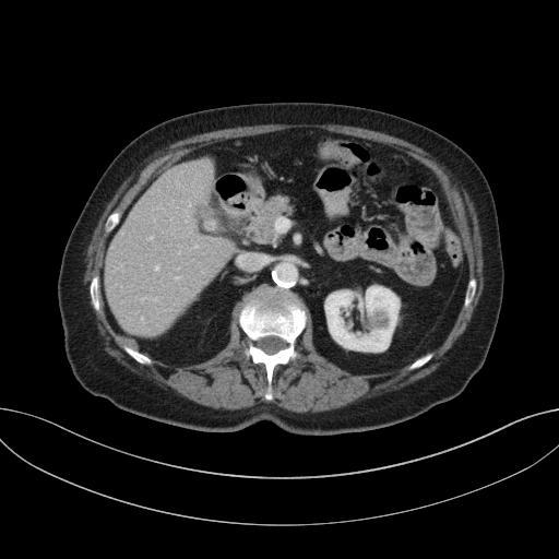 Cholecystoduodenal fistula due to calculous cholecystitis with gallstone migration (Radiopaedia 86875-103077 D 32).jpg