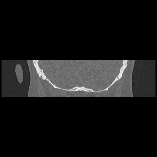 Cholesteatoma (Radiopaedia 84946-100455 Coronal bone window 132).jpg