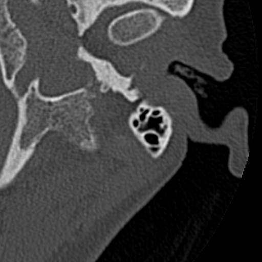 File:Cholesteatoma of the external ear (Radiopaedia 16540-16225 Axial bone window 34).jpg