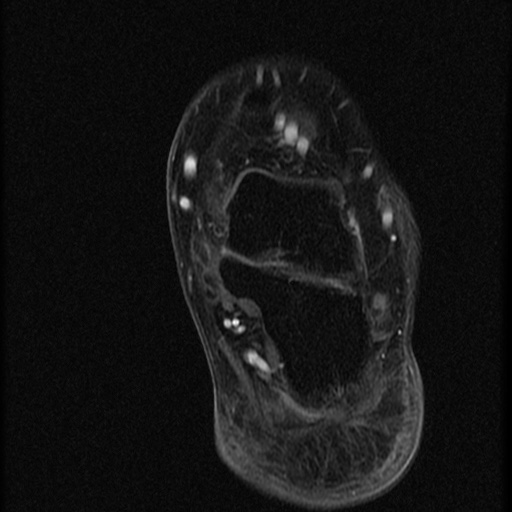 File:Chondroblastoma - midfoot (Radiopaedia 64831-73765 G 2).jpg