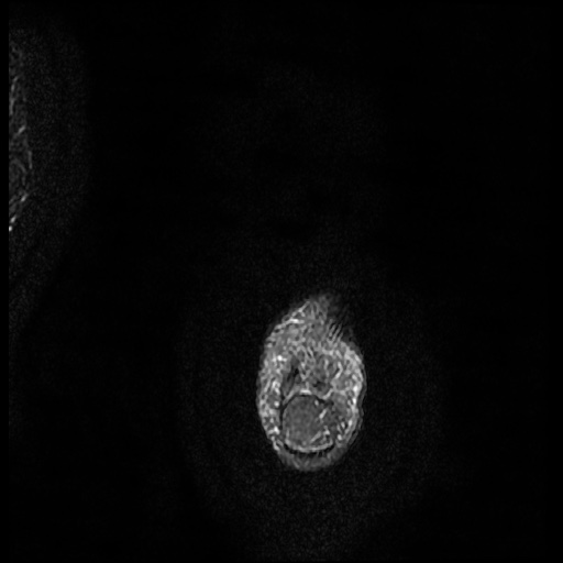File:Chondroblastoma - midfoot (Radiopaedia 64831-73765 Long axis T2 fat sat 1).jpg