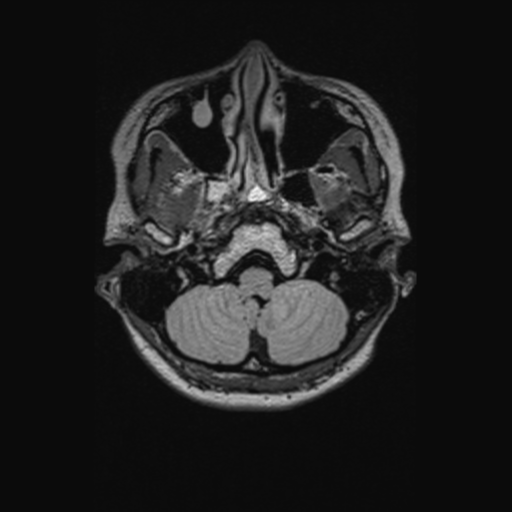 Chondrosarcoma (Radiopaedia 41937-44939 Axial FLAIR 22).png