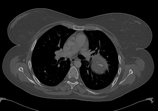 Chondrosarcoma - chest wall (Radiopaedia 65192-74199 Axial bone window 55).jpg