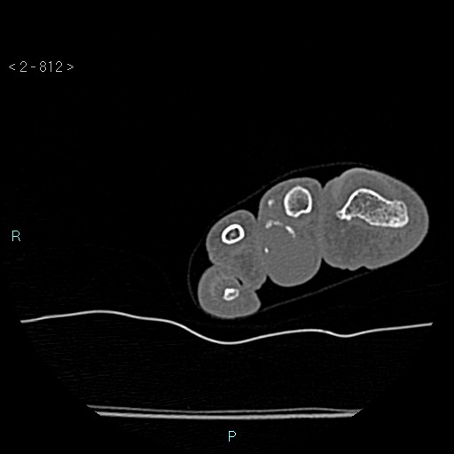 File:Chondrosarcoma - phalanx (Radiopaedia 69047-78812 Axial bone window 66).jpg