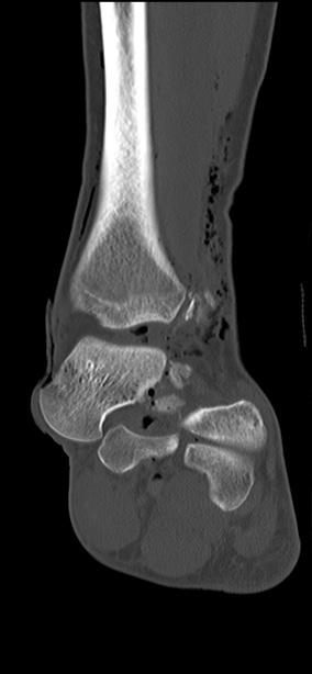 Chopart fracture (Radiopaedia 35347-36851 Coronal bone window 38).jpg