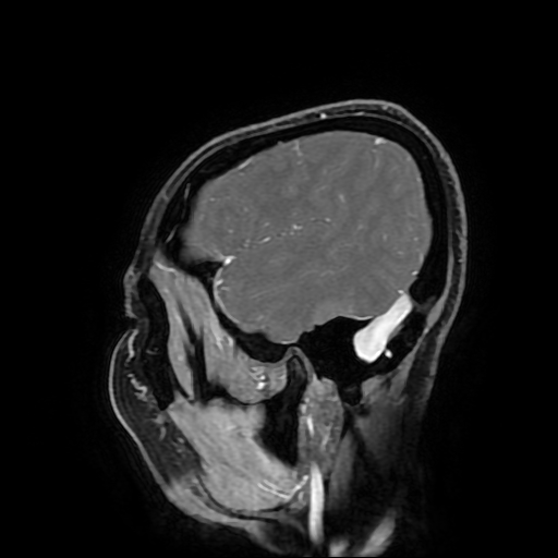 Chordoid glioma of third ventricle (Radiopaedia 91612-109340 F 45).jpg