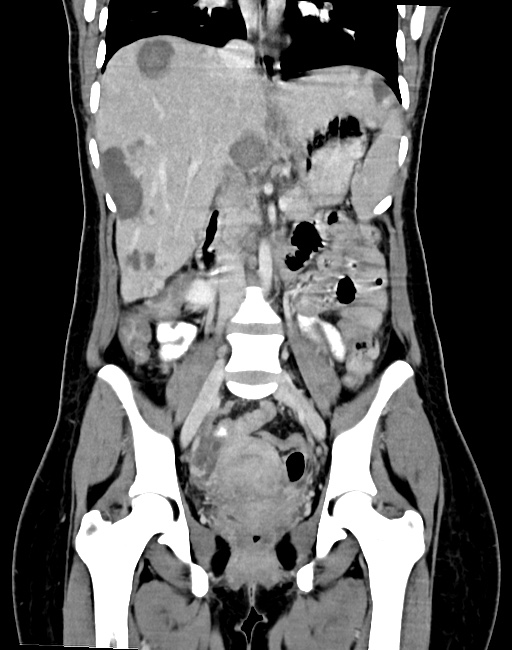 Choriocarcinoma liver metastases (Radiopaedia 74768-85766 B 55).jpg