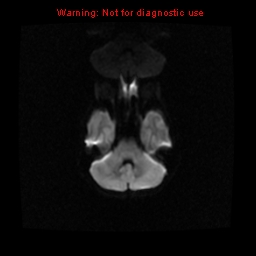 File:Choroid plexus carcinoma - recurrent (Radiopaedia 8330-9169 Axial DWI 6).jpg