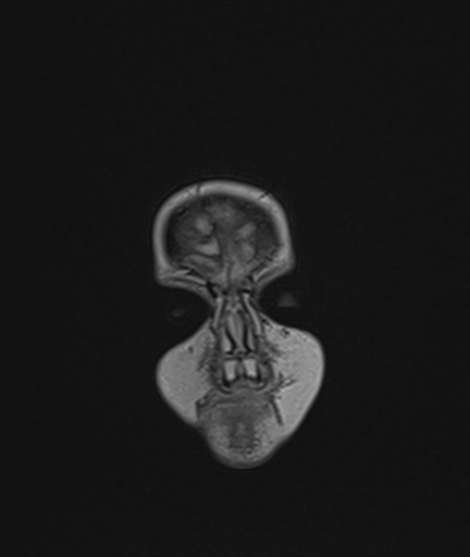 Choroid plexus papilloma (Radiopaedia 84612-100019 Coronal FLAIR 1).jpg