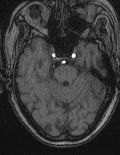 Choroid plexus xanthogranuloma - unilateral (Radiopaedia 85632-101393 Axial TOF 10).jpg