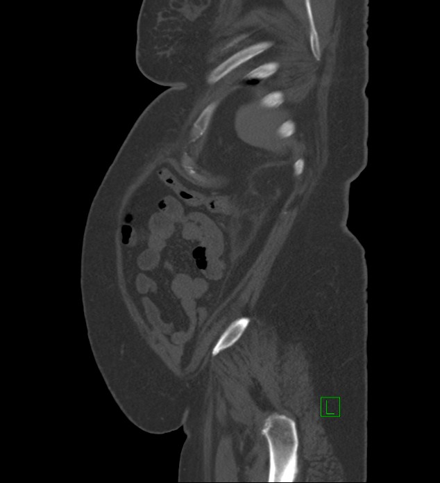 Chromophobe renal cell carcinoma (Radiopaedia 84239-99519 Sagittal bone window 13).jpg