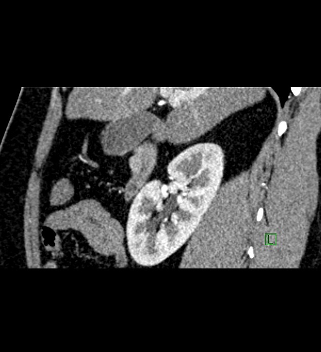 Chromophobe renal cell carcinoma (Radiopaedia 84286-99573 F 114).jpg