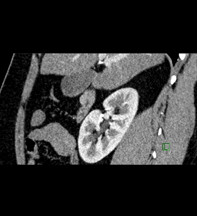 Chromophobe renal cell carcinoma (Radiopaedia 84286-99573 F 115).jpg