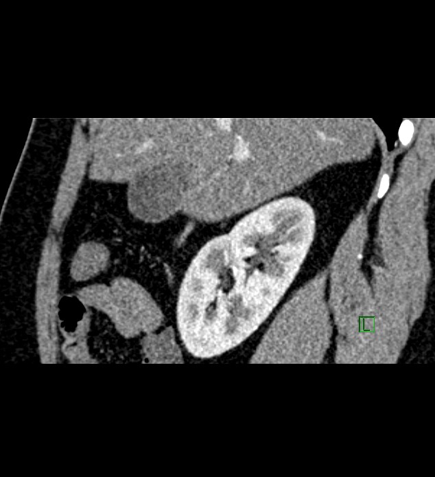 Chromophobe renal cell carcinoma (Radiopaedia 84286-99573 F 121).jpg