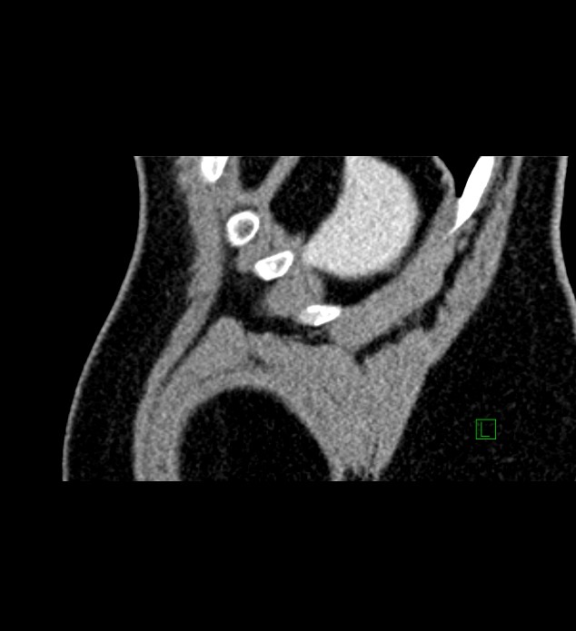 Chromophobe renal cell carcinoma (Radiopaedia 84286-99573 F 2).jpg