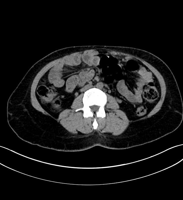 Chromophobe renal cell carcinoma (Radiopaedia 84290-99582 Axial non-contrast 75).jpg