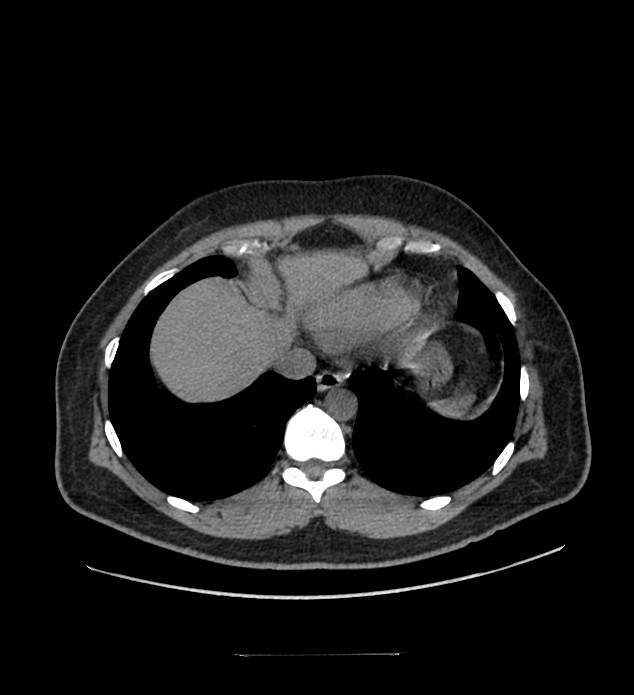 Chromophobe renal cell carcinoma (Radiopaedia 84337-99644 Axial non-contrast 7).jpg